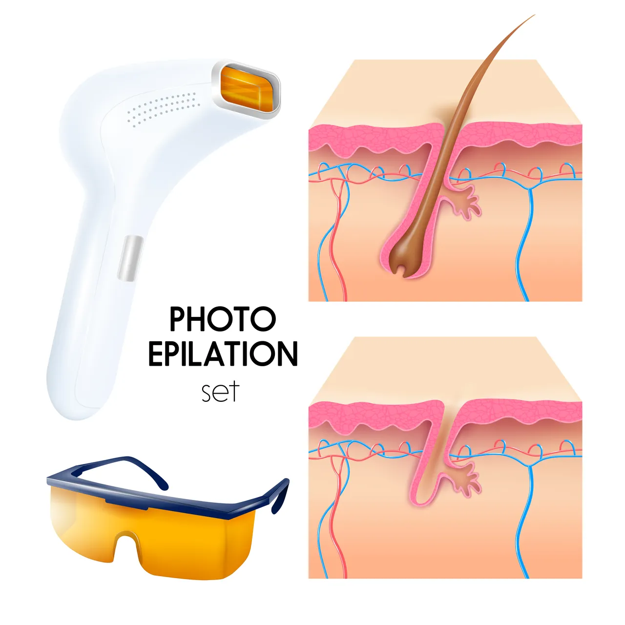 How Laser Hair Removal Works