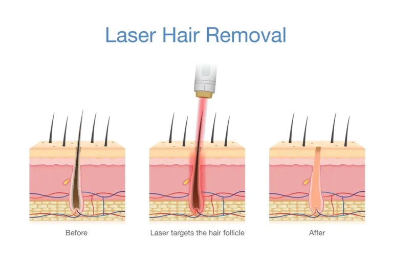 How Laser Hair Removal Works: The Ultimate Guide to Smooth Skin