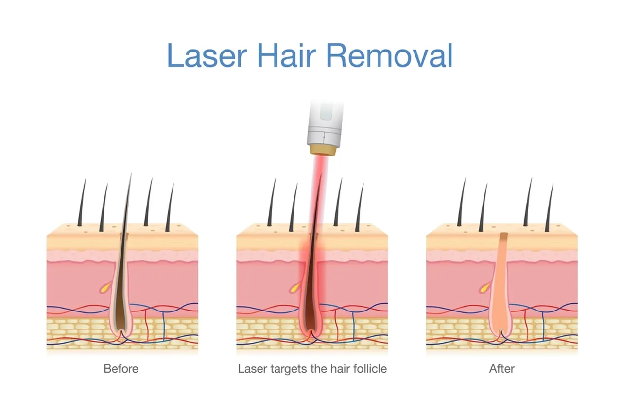 How Laser Hair Removal Works