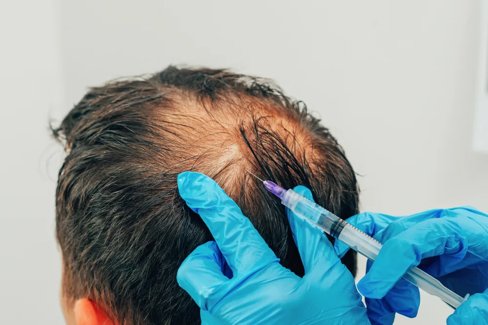 the Cost of PRP for Hair Treatment
