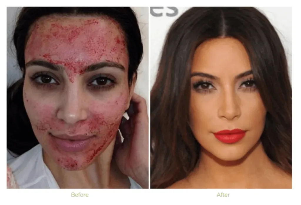 Vampire Facial Before and After Acne Scars