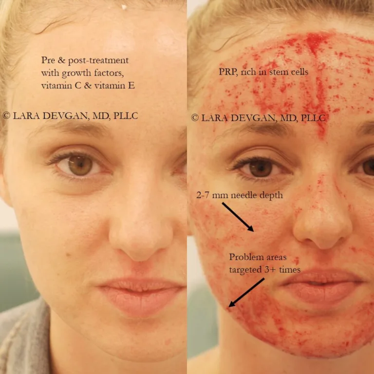 Vampire Facial vs. Microneedling: Choosing the Best Skin Rejuvenation Treatment