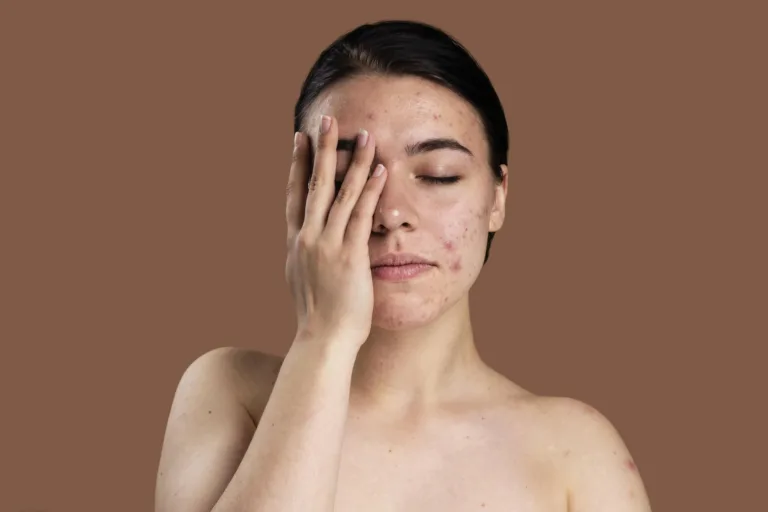 Plasma for Acne Scars: An Effective Treatment Option for Skin Rejuvenation