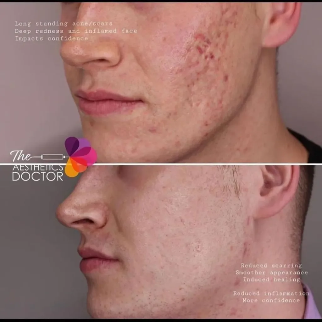 vampire facial before and after acne scars