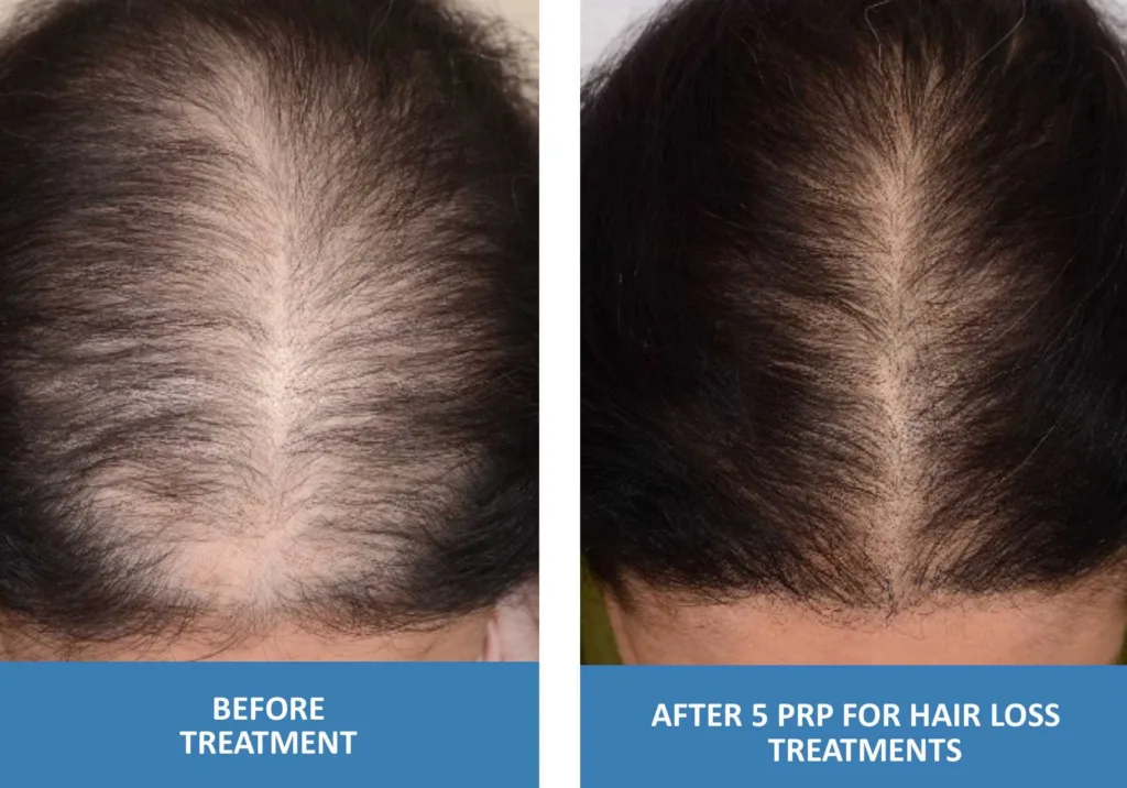 PRP-For-Hair-Loss-Before-And-After-Photo-Female-5-Treatments-Platelet-Rich-Plasma-in-Springfield-Missouri