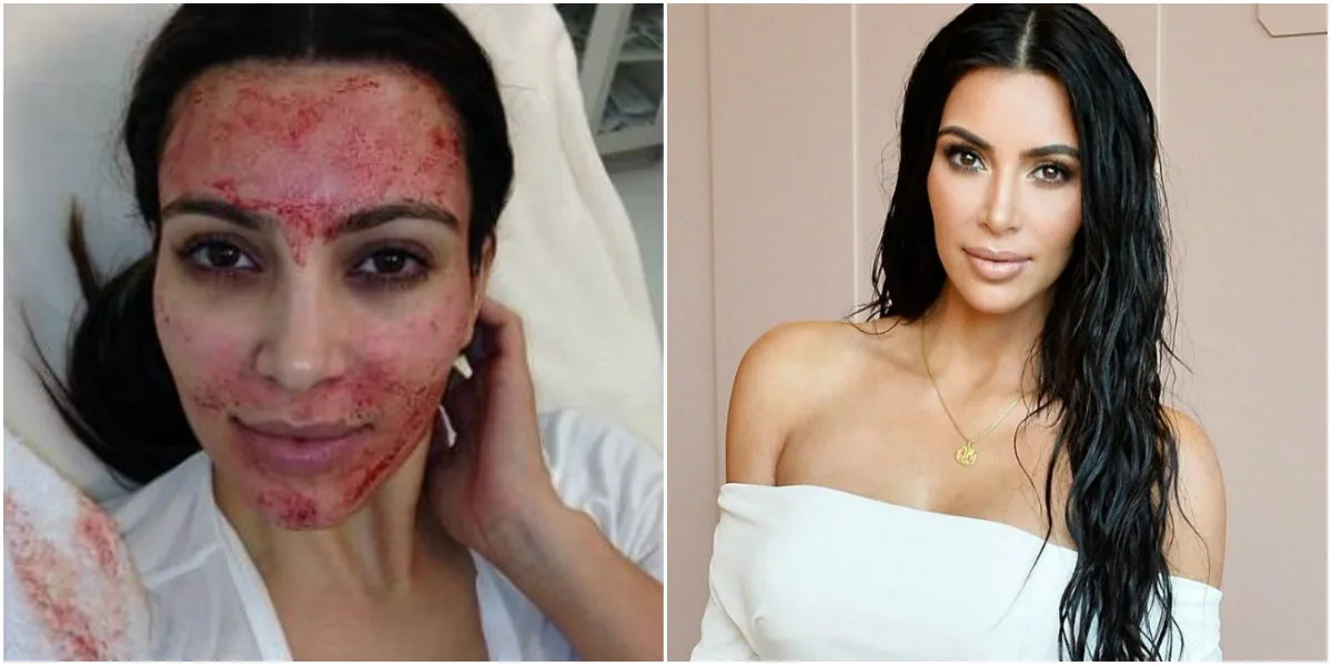 Celebrities that Done PRP Treatments - Kim Kardashian