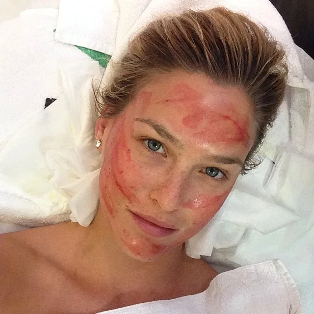 Celebrities that Done PRP Treatments - Bar Refaeli