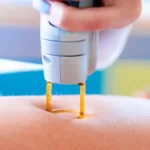 Hair Laser Removal at Home: What You Need to Know