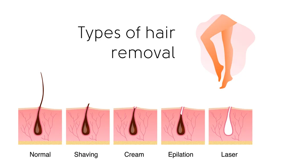 Popular methods of hair removal: shaving, cream, epilator, and laser.